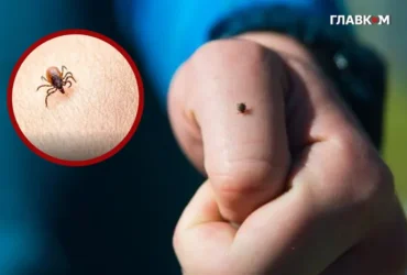 Кліщ у дитини: лікарка з Києва дала поради батькам